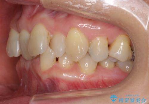 50代女性 インビザライン かみ合わせが深く、難しい症例の治療前