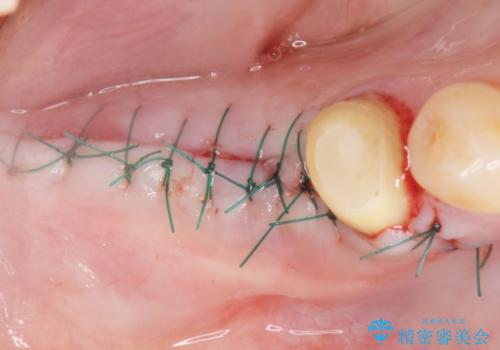 奥歯が割れている 抜歯してインプラントへ 40代女性の治療中