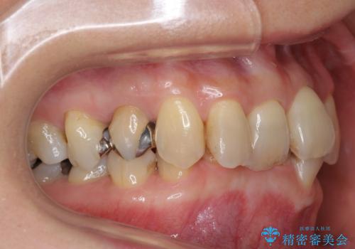 50代女性 インビザライン かみ合わせが深く、難しい症例の治療前