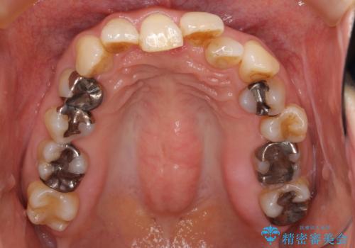 50代女性 インビザライン かみ合わせが深く、難しい症例の治療前