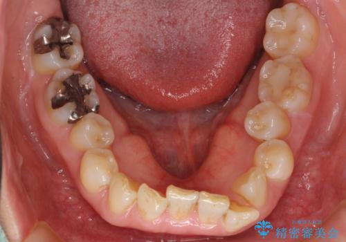 50代女性 インビザライン かみ合わせが深く、難しい症例の治療前