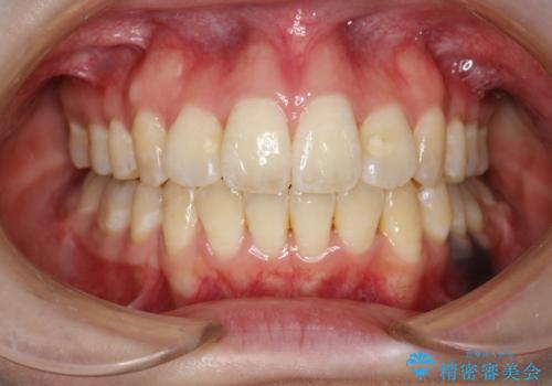 重度のガタガタ ワイヤーによる抜歯矯正の治療後