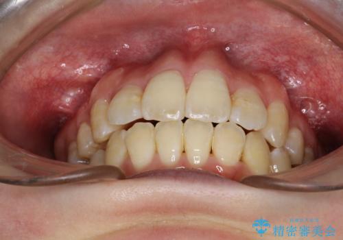 重度のガタガタ ワイヤーによる抜歯矯正の治療後