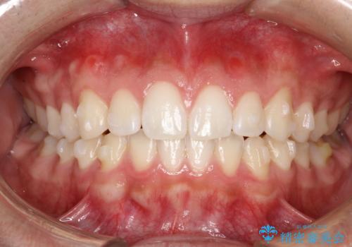 前歯の隙間がきになる インビザラインですきっ歯の治療の治療中