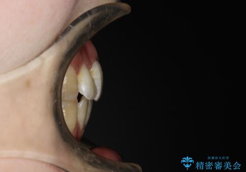重度のガタガタ ワイヤーによる抜歯矯正の治療後