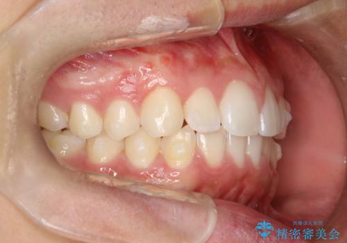 前歯の隙間がきになる　インビザラインですきっ歯の治療の治療中