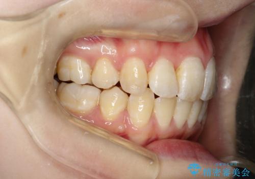 重度のガタガタ ワイヤーによる抜歯矯正の症例 治療後