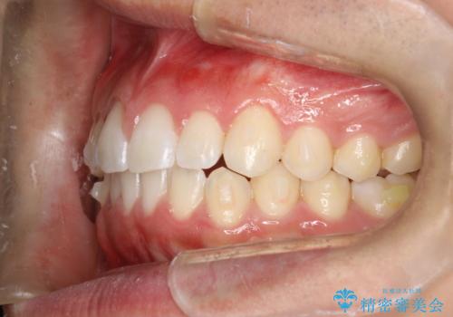 前歯の隙間がきになる　インビザラインですきっ歯の治療の治療中