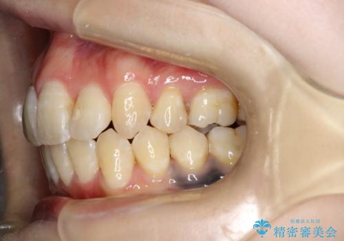 重度のガタガタ ワイヤーによる抜歯矯正の治療後