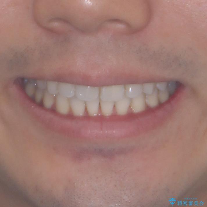 上顎の狭い歯列をインビザラインで拡大の治療後（顔貌）