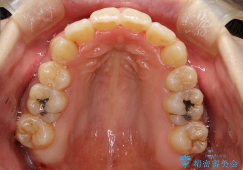 重度のガタガタ ワイヤーによる抜歯矯正の治療後