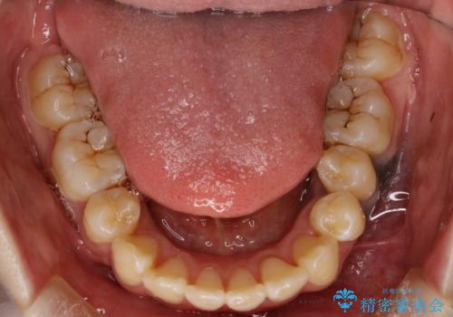 重度のガタガタ ワイヤーによる抜歯矯正の治療後