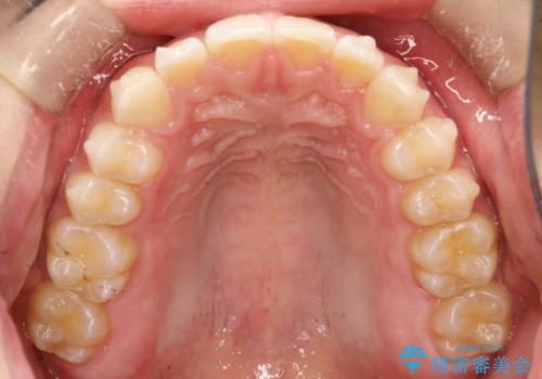 前歯の隙間がきになる インビザラインですきっ歯の治療の治療中