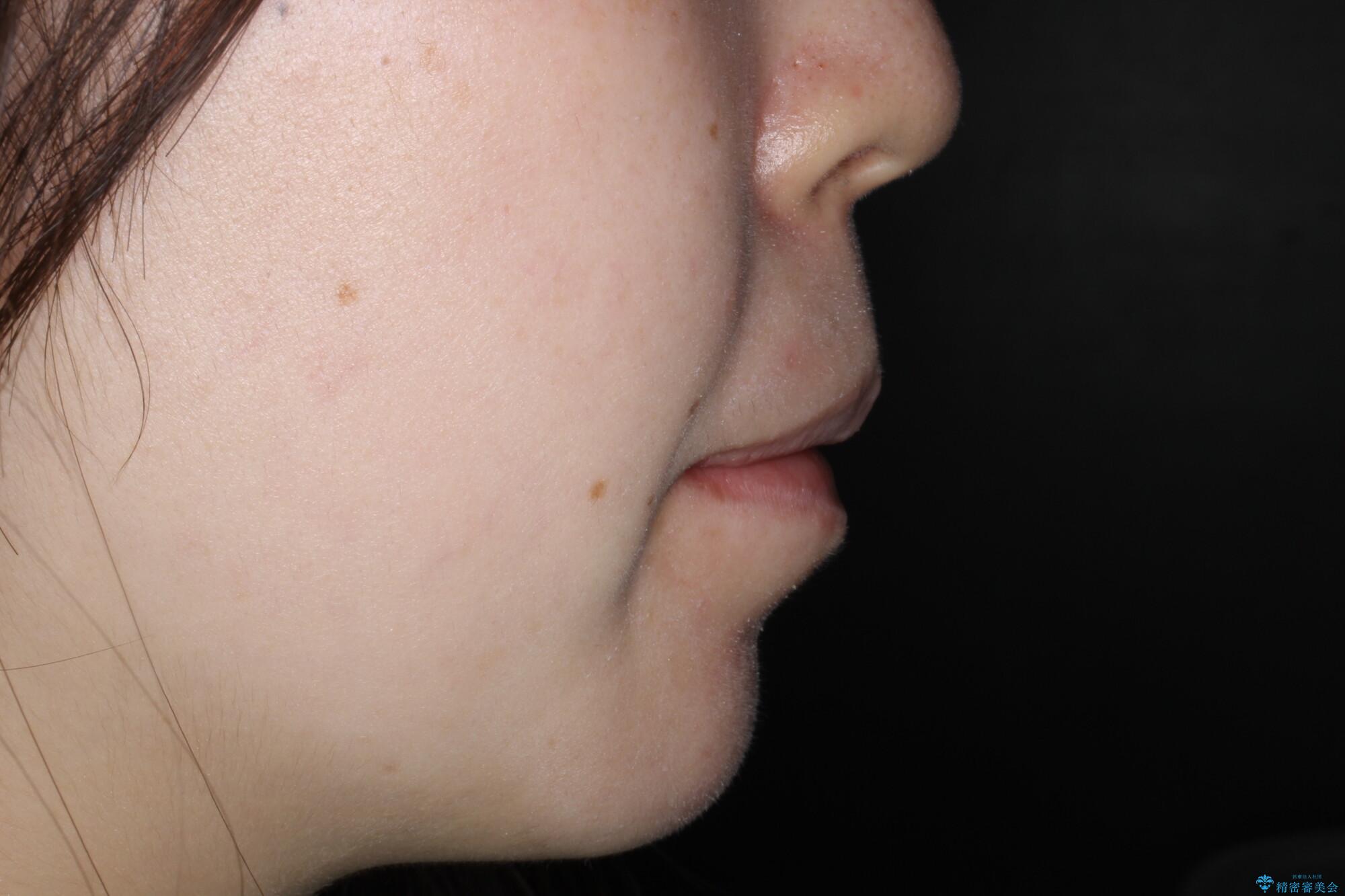 重度のガタガタ ワイヤーによる抜歯矯正の治療後(顔貌)