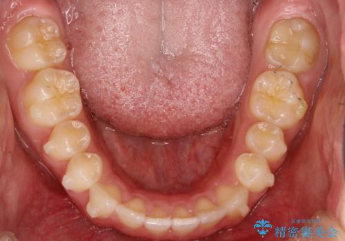 前歯の隙間がきになる インビザラインですきっ歯の治療の治療中