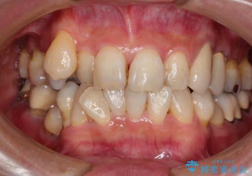 歯並びや奥歯の痛み　色々と治したい　総合歯科診療の症例 治療前