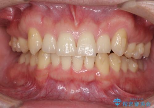 気になる八重歯を抜歯矯正で改善 補助装置を用いたインビザライン矯正の治療中