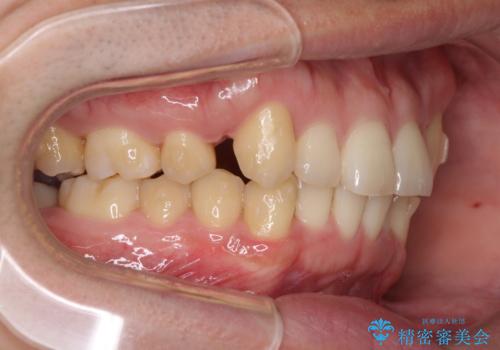 気になる八重歯を抜歯矯正で改善　補助装置を用いたインビザライン矯正の治療中