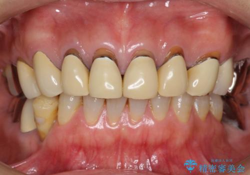 長持ちするセラミック 4年半経過症例 50代女性の治療前