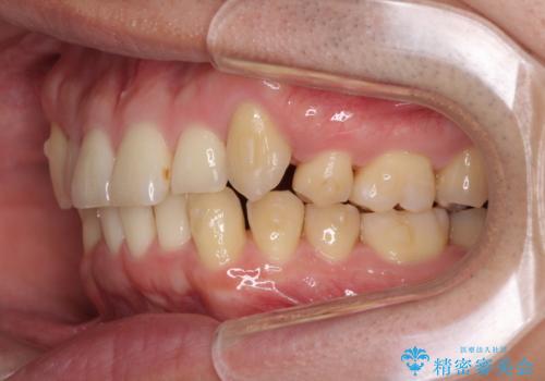 気になる八重歯を抜歯矯正で改善　補助装置を用いたインビザライン矯正の治療中