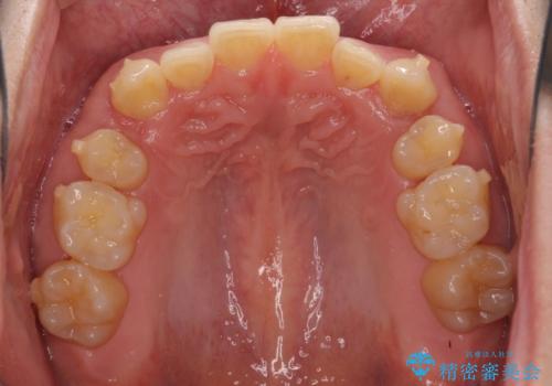 気になる八重歯を抜歯矯正で改善 補助装置を用いたインビザライン矯正の治療中