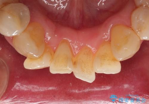 歯並びや奥歯の痛み　色々と治したい　総合歯科診療の治療前