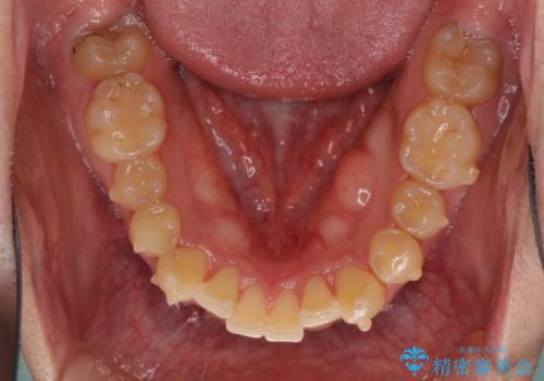 気になる八重歯を抜歯矯正で改善 補助装置を用いたインビザライン矯正の治療中