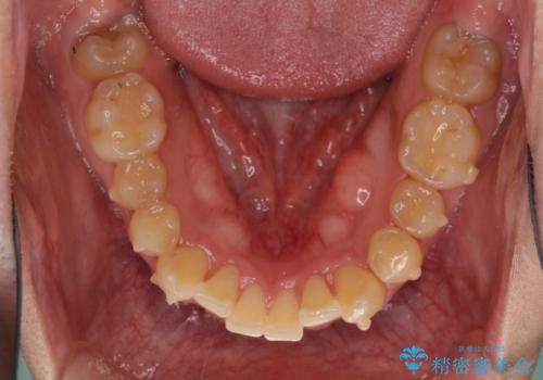 気になる八重歯を抜歯矯正で改善　補助装置を用いたインビザライン矯正の治療中