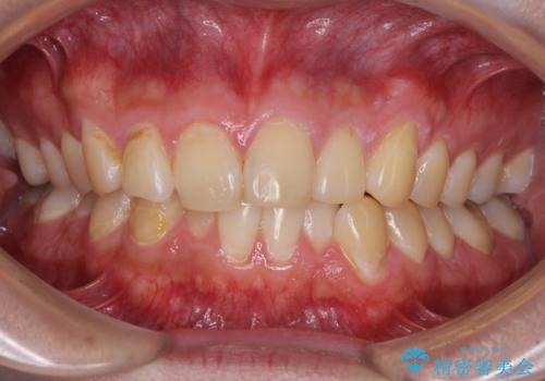 気になる前歯を治したい　短期間でのインビザライン矯正の症例 治療前
