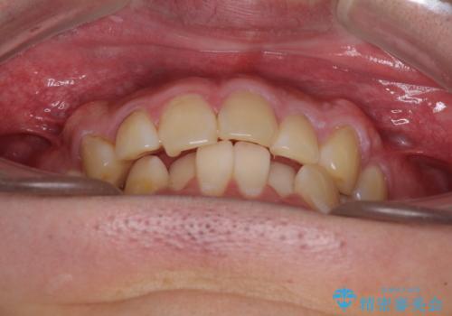 気になる前歯を治したい　短期間でのインビザライン矯正の治療前