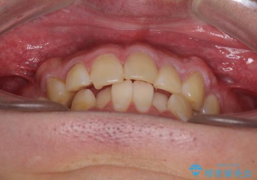 気になる前歯を治したい 短期間でのインビザライン矯正の治療前