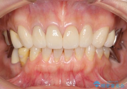 長持ちするセラミック 4年半経過症例 50代女性の治療中