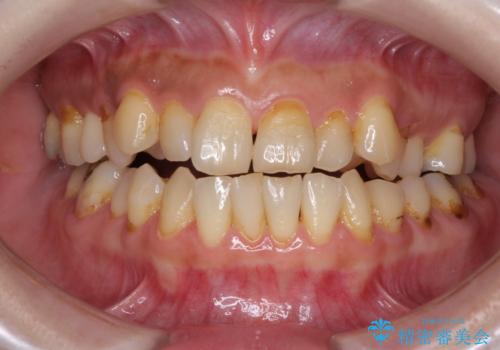 どこで咬んで良いのか分からない インビザラインでの咬み合わせの改善の症例 治療前