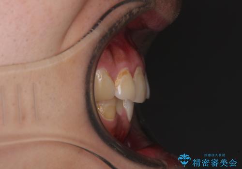 気になる前歯を治したい 短期間でのインビザライン矯正の治療前