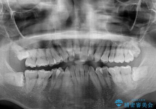 掃除しにくい前歯と閉じにくい口元 目立たないワイヤー装置での抜歯矯正の治療前