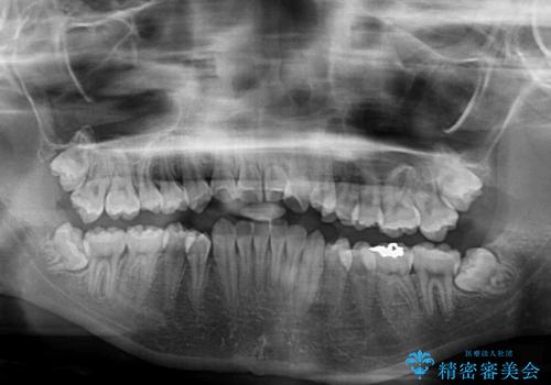 急速拡大装置で狭い歯列を骨格ごと改善 ワイヤー装置による矯正治療の治療前