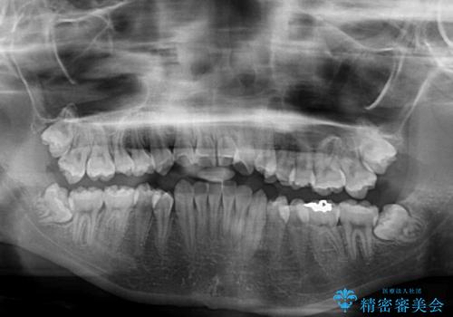 急速拡大装置で狭い歯列を骨格ごと改善　ワイヤー装置による矯正治療の治療前