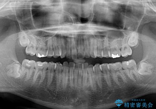 気になる前歯を治したい 短期間でのインビザライン矯正の治療前