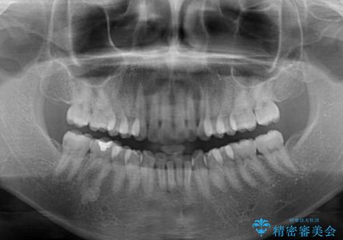 ふっくらとした口元を改善したい 目立たないワイヤー装置による抜歯矯正の治療前