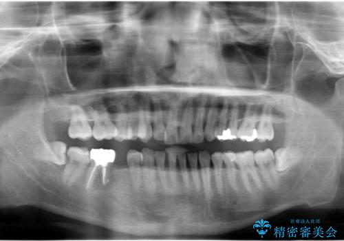 親知らずのせいで隣の歯が虫歯に　40代男性の治療前