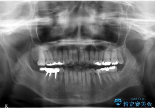 奥歯が割れている 抜歯してインプラントへ 40代女性の治療前