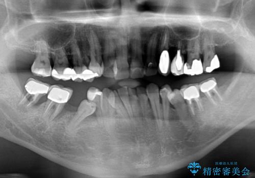 歯並びや奥歯の痛み 色々と治したい 総合歯科診療の治療前