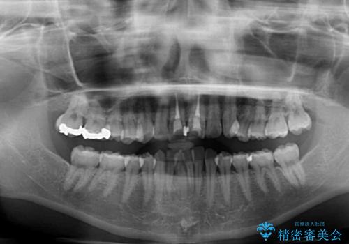 上下前歯のデコボコをきれいに インビザラインによる矯正治療の治療前