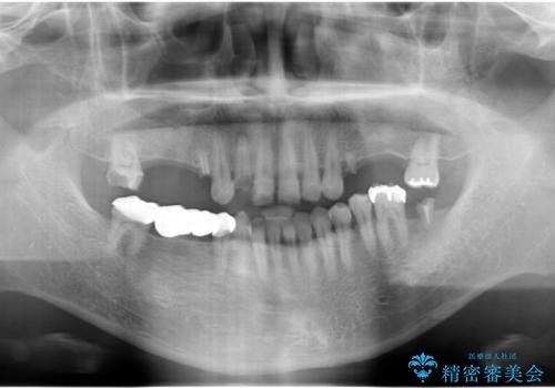 インプラント治療・セラミック治療を含む  全顎的虫歯治療の治療前