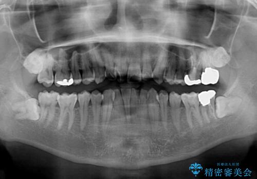 上顎の狭い歯列をインビザラインで拡大の治療前