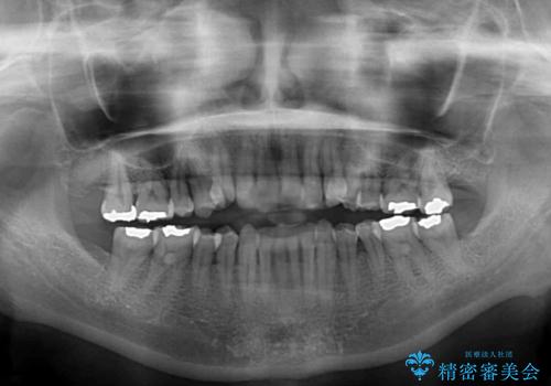 どこで咬んで良いのか分からない インビザラインでの咬み合わせの改善の治療前