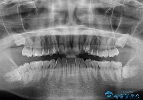 気になる八重歯を抜歯矯正で改善 補助装置を用いたインビザライン矯正の治療前