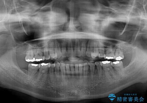 どこで咬んで良いのか分からない インビザラインでの咬み合わせの改善の治療後