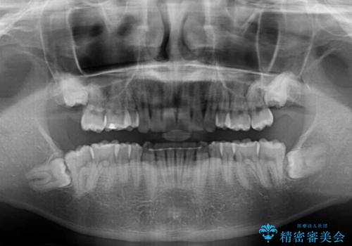 気になる八重歯を抜歯矯正で改善 補助装置を用いたインビザライン矯正の治療後