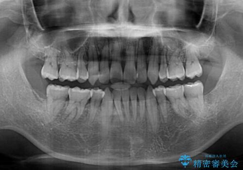 掃除しにくい前歯と閉じにくい口元　目立たないワイヤー装置での抜歯矯正の治療後
